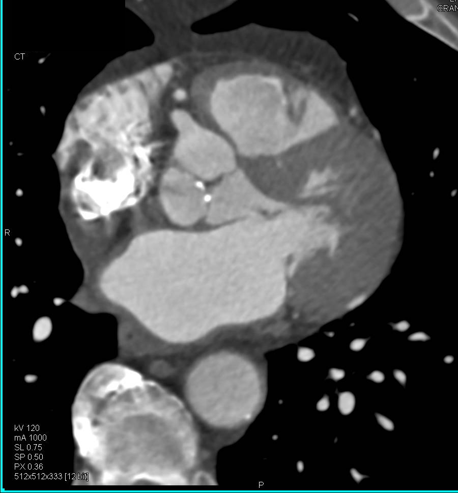 Aortic Valve Calcification - CTisus CT Scan