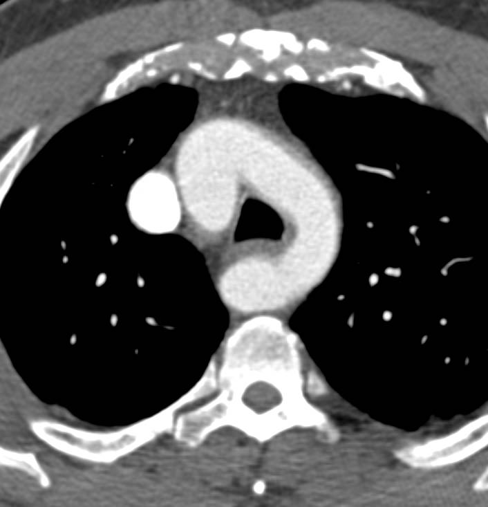 Double Aortic Arch with Mirror Branching - CTisus CT Scan