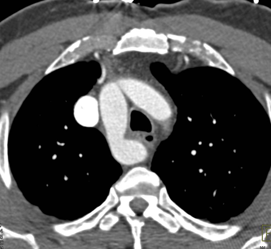 Double Aortic Arch with Mirror Branching - CTisus CT Scan