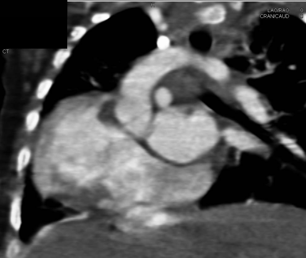 Post Repair of Tetralogy of Fallot - CTisus CT Scan