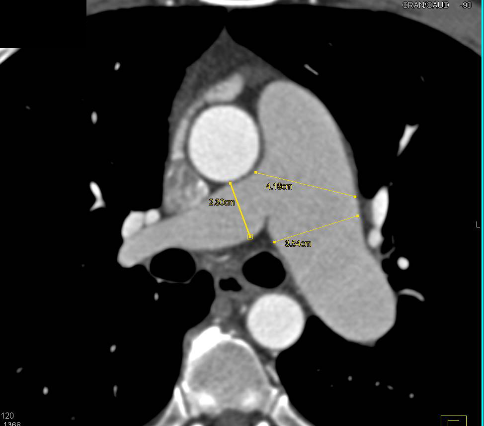 Dilated Main Pulmonary Arteries with Good Visualization of Pulmonary Valve - CTisus CT Scan