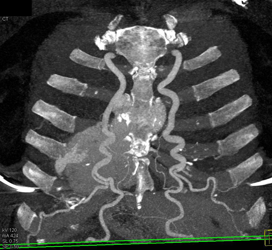 Coarctation of the Aorta with Intercostal Collaterals and Dilated Internal Mammary Arteries - CTisus CT Scan