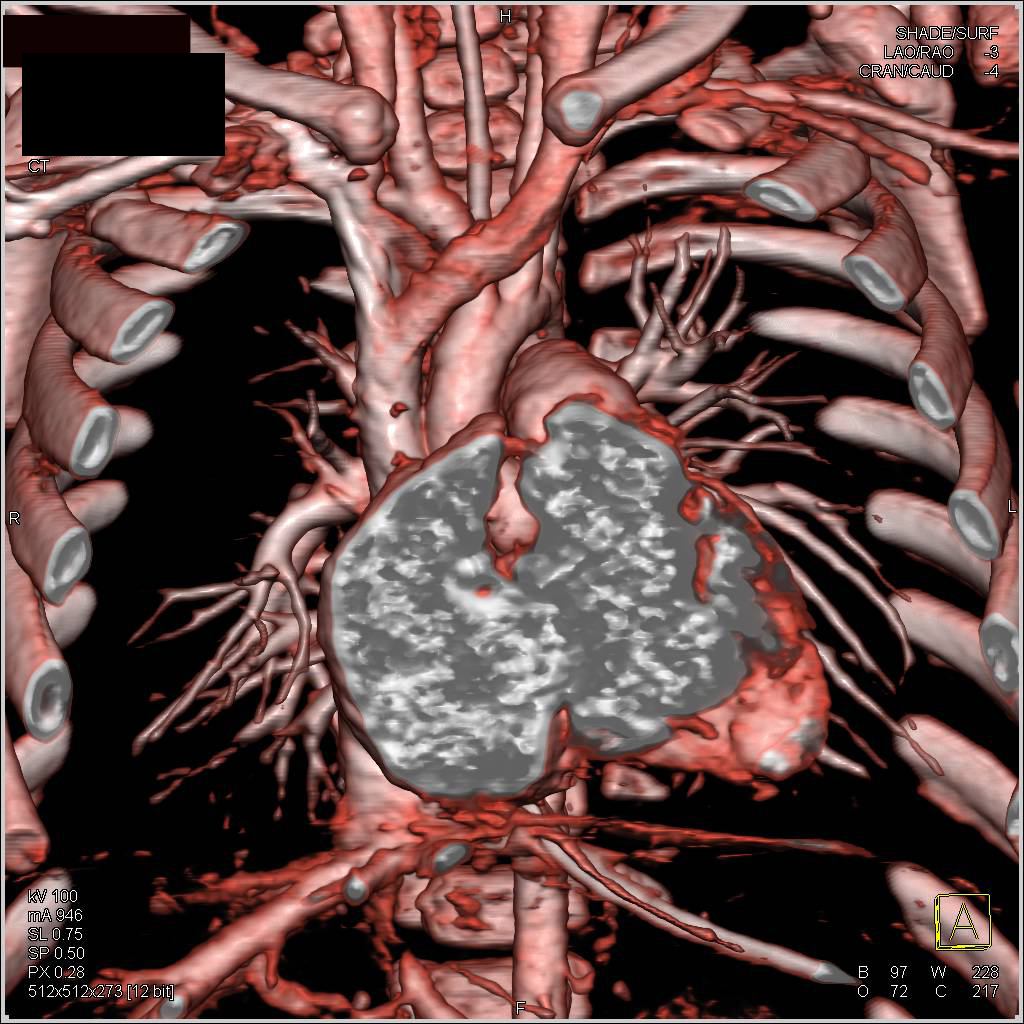 Right Pulmonary Vein Stenosis in 3D - CTisus CT Scan