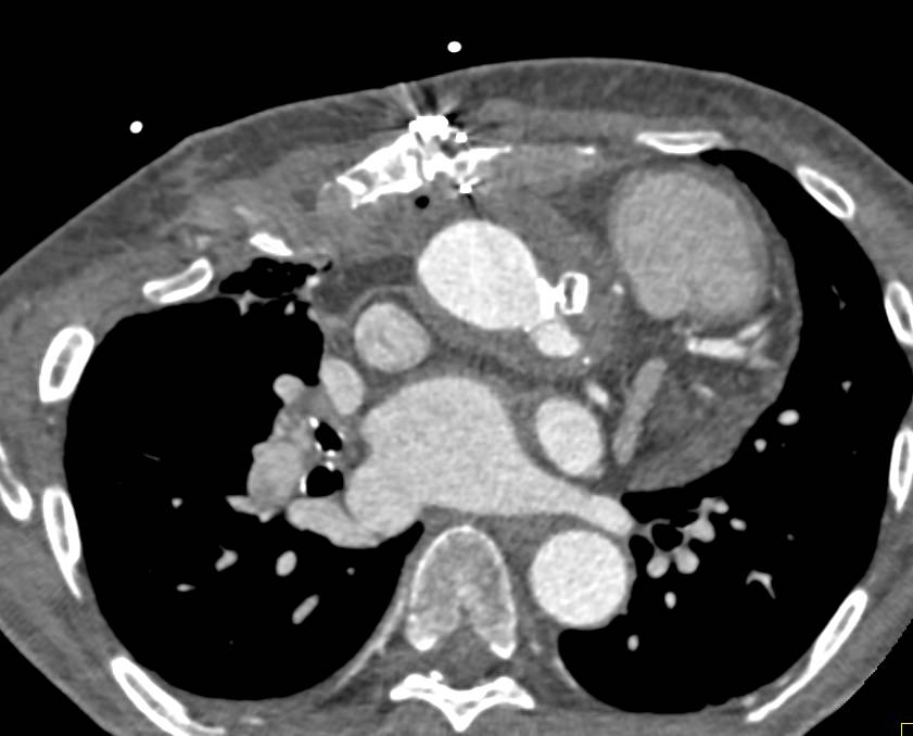 Repair of Aortic Pseudoaneurysm with Intruder Devise - CTisus CT Scan