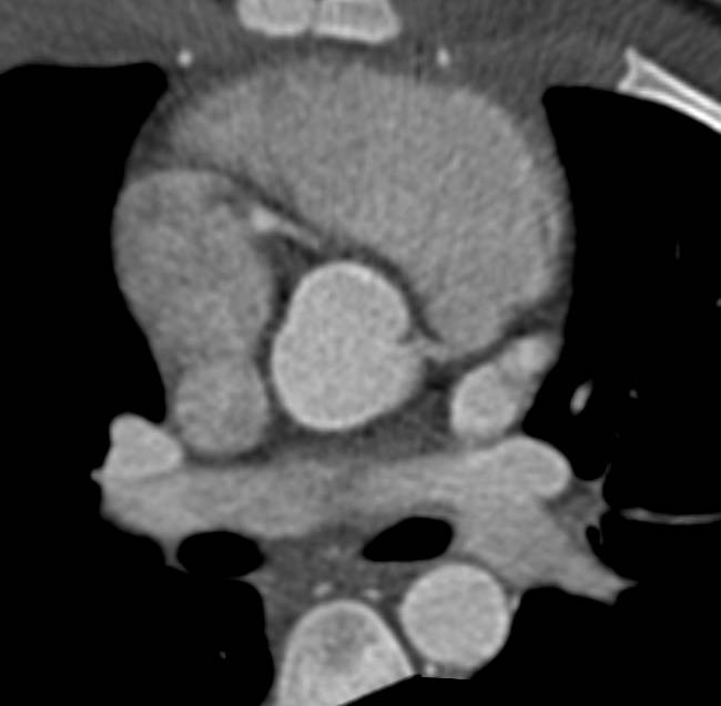 Large Pericardial Effusion - CTisus CT Scan