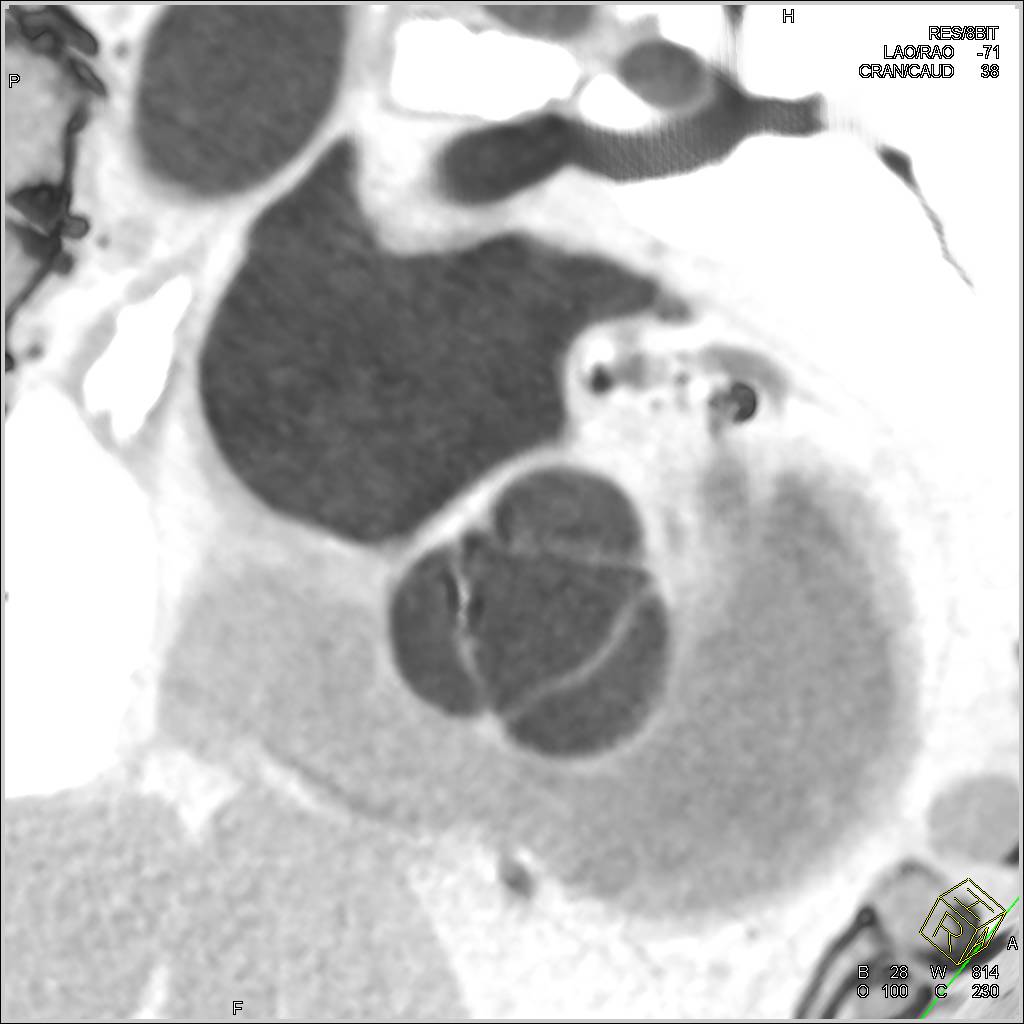 Normal Aortic Valve - CTisus CT Scan