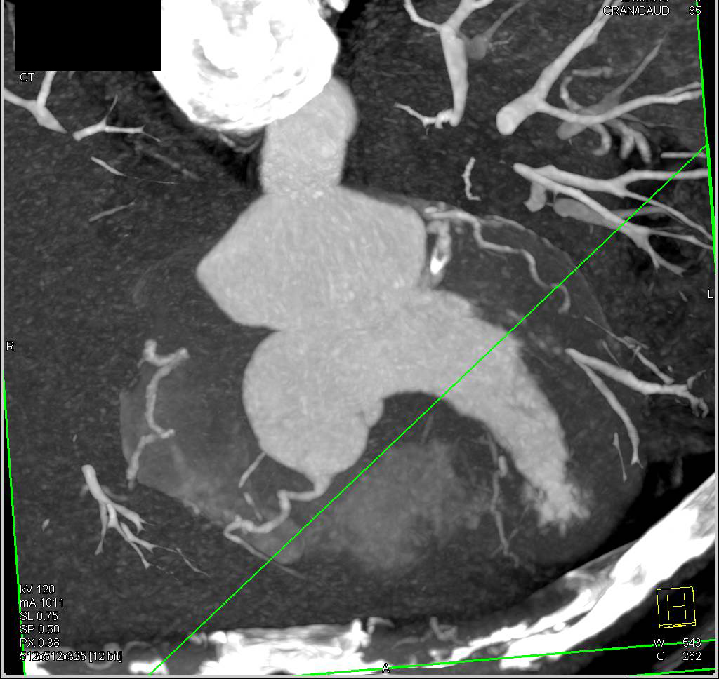 Thick Wall Left Wall Ventricle - CTisus CT Scan