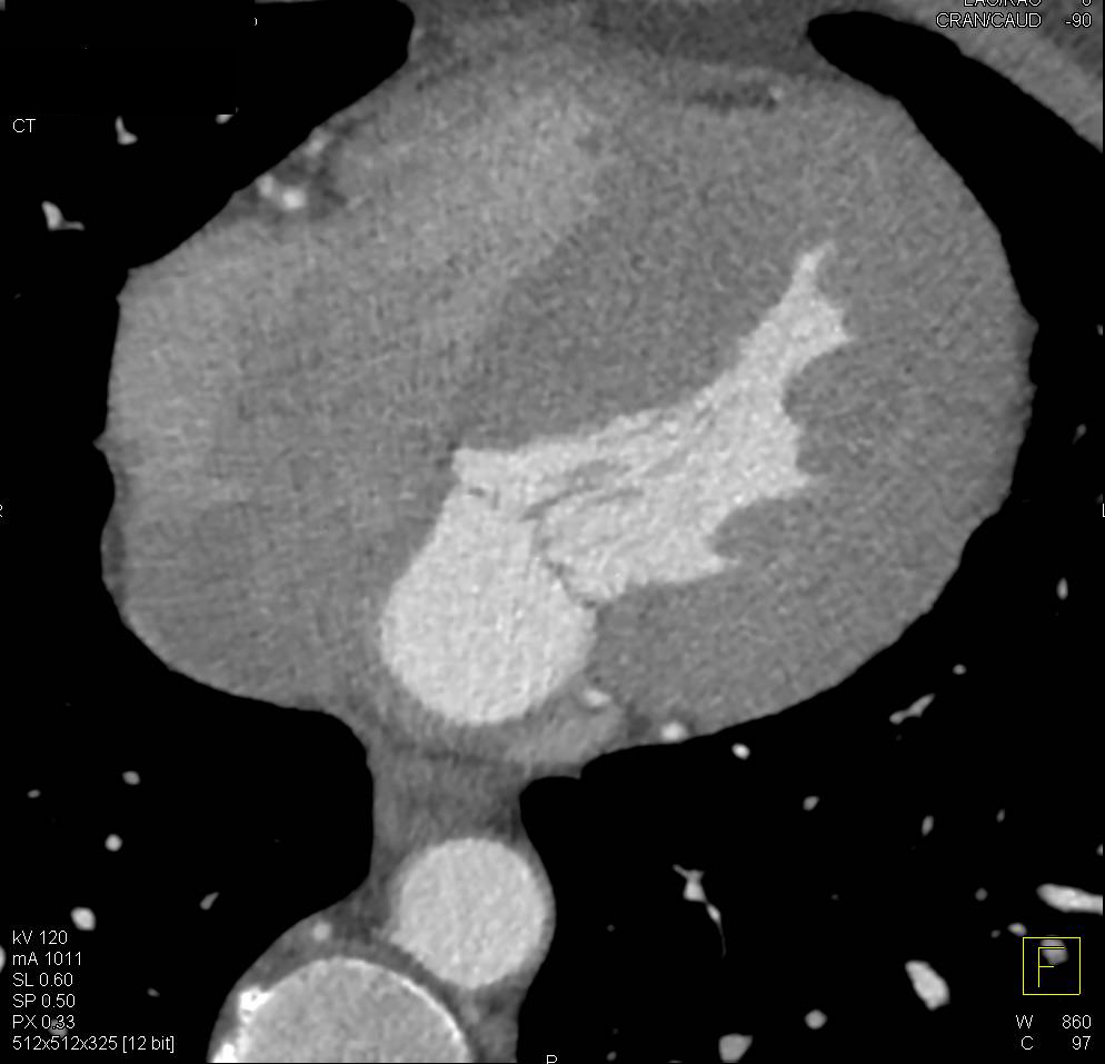 Hypertrophic Cardiomyopathy Left Ventricle - CTisus CT Scan