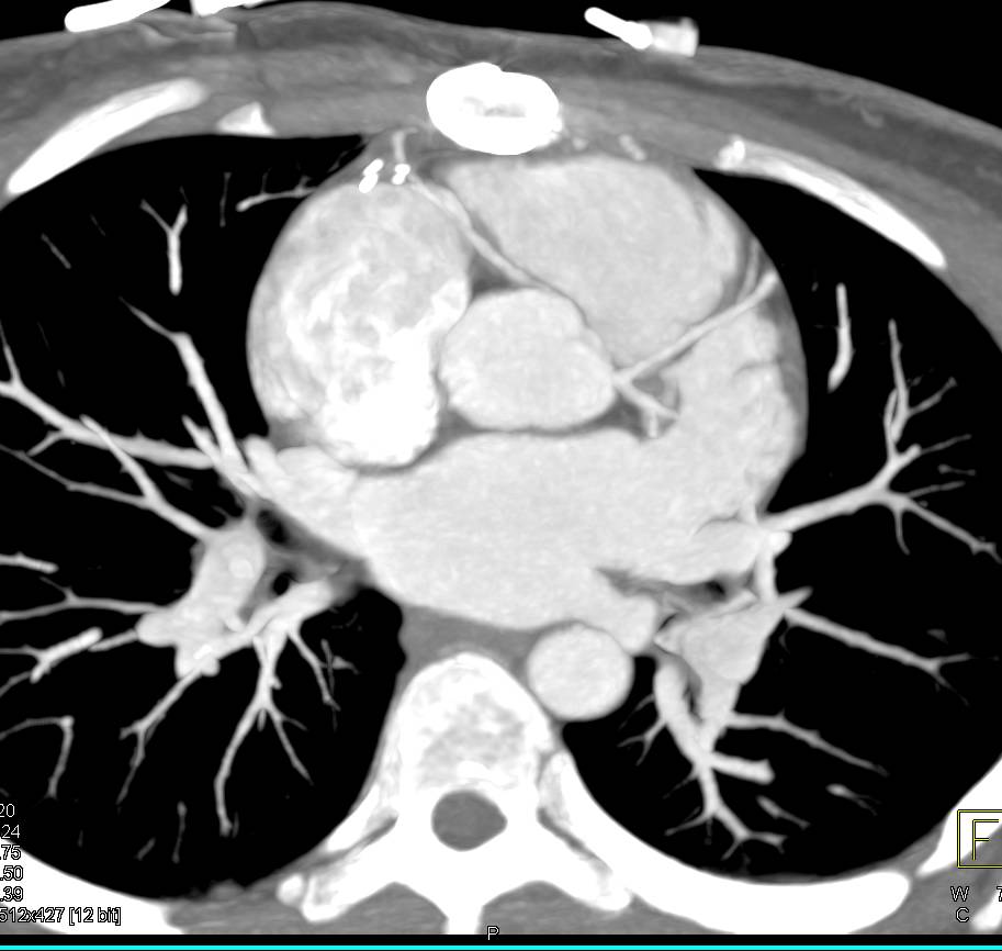 CCTA: Right Coronary Artery Arises off the Left Cusp in a Malignant Configuration - CTisus CT Scan