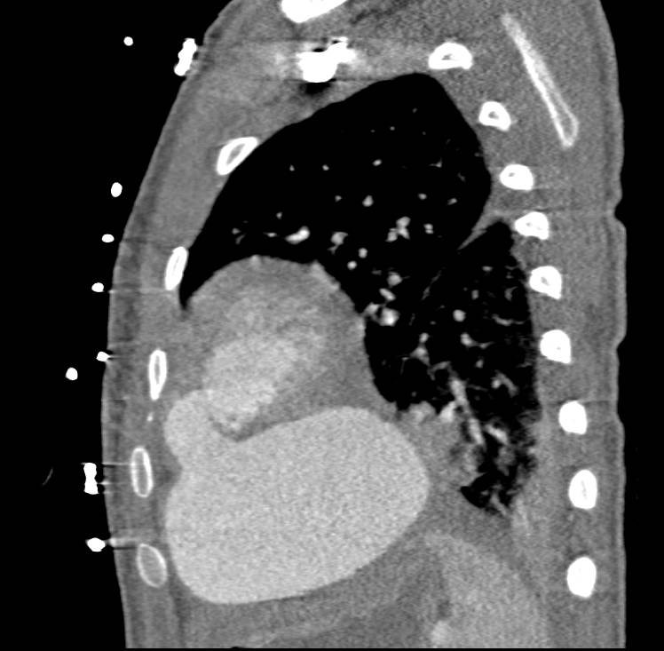 Pseudoaneurysm off Left Ventricle Following Gunshot Wound to Heart - CTisus CT Scan