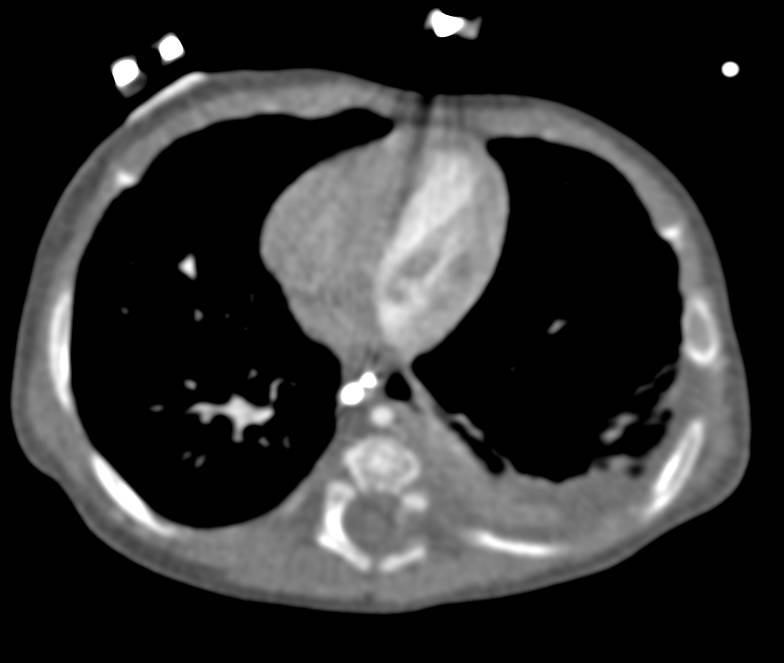 Surgical Clip Across PDA (Patent Ductus Arteriosus) - CTisus CT Scan