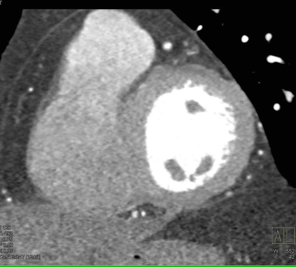 CCTA: Left Anterior Descending Coronary Artery (LAD) Occlusion - CTisus CT Scan