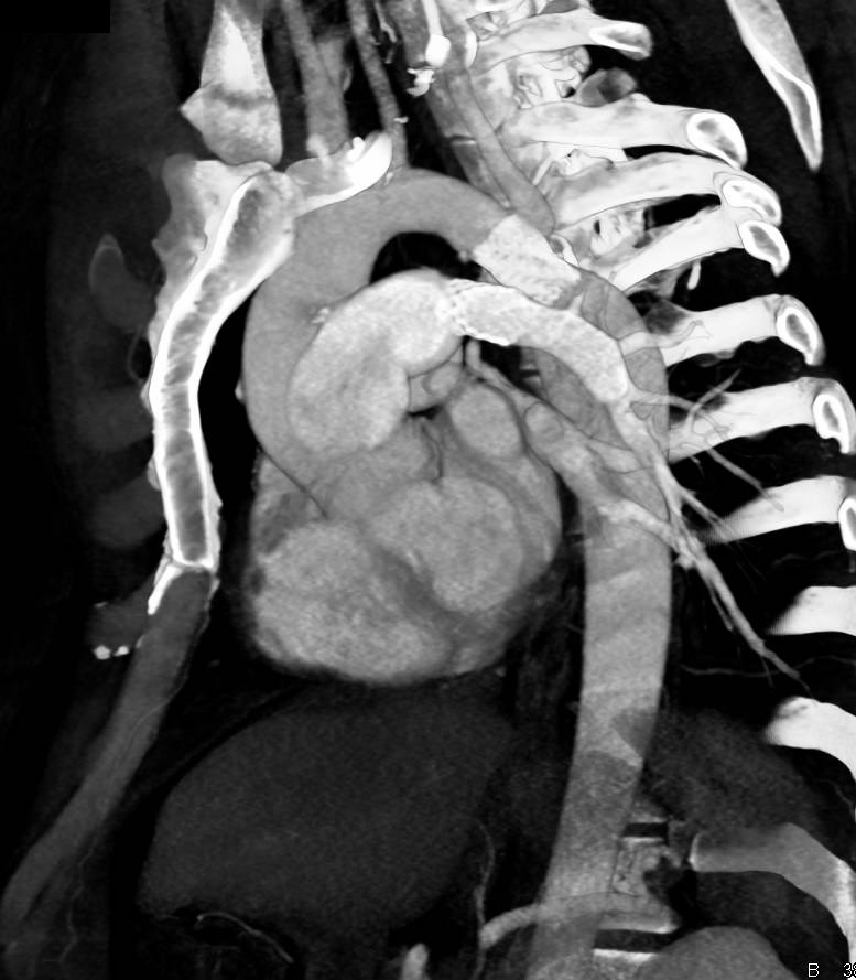 Stent for Repair of Coarctation of the Aorta as well as Pulmonary Artery Stent - CTisus CT Scan