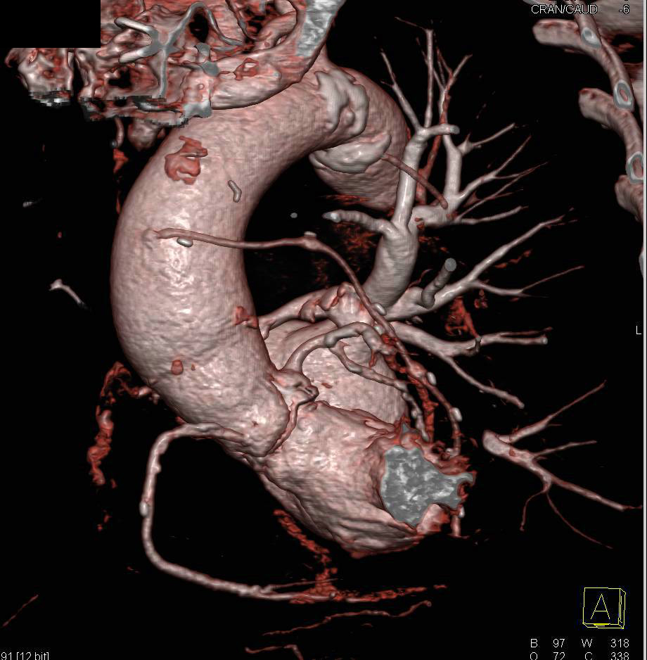 Aortic Valve Replacement and Coronary Artery Bypass Graft (CABG) - CTisus CT Scan