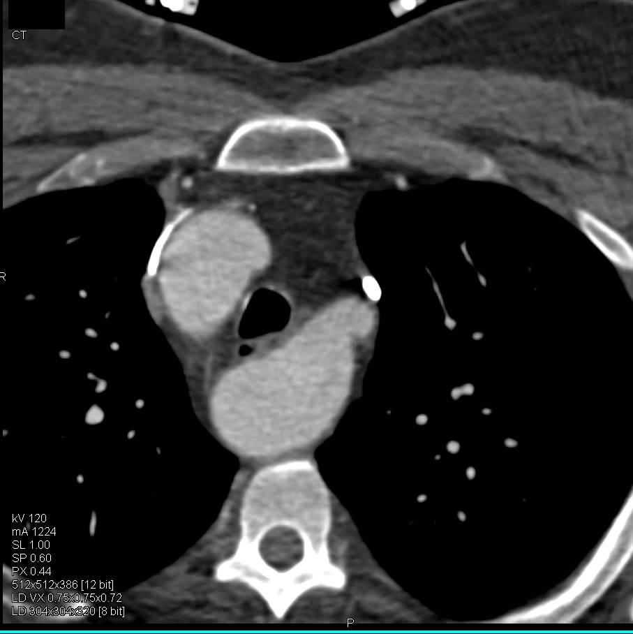 Right Aortic Arch with Aberrant Left Subclavian Artery - CTisus CT Scan