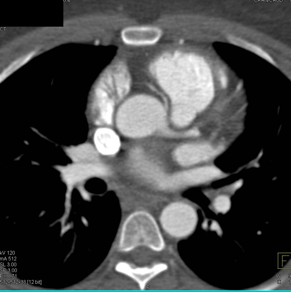 CCTA: Right Coronary Artery Arises off the Left Cusp in Malignant Configuration - CTisus CT Scan