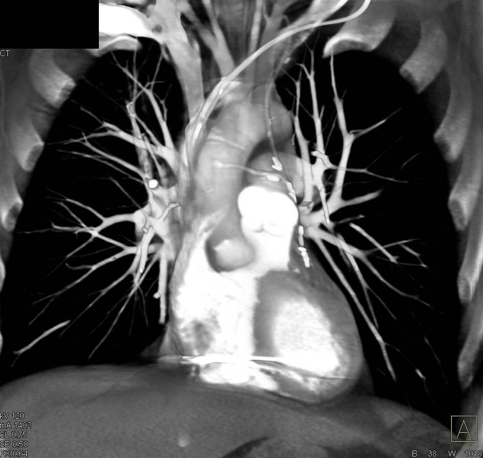 Coronary Artery Bypass Graft (CABG) with Changes in Sternum Post Repair - CTisus CT Scan