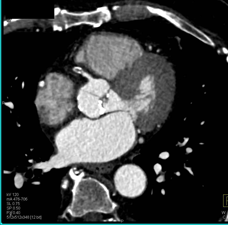 Aortic Valve Stenosis with Calcified Valve Leaflets and Coronary Artery Bypass Grafts (CABGs) - CTisus CT Scan