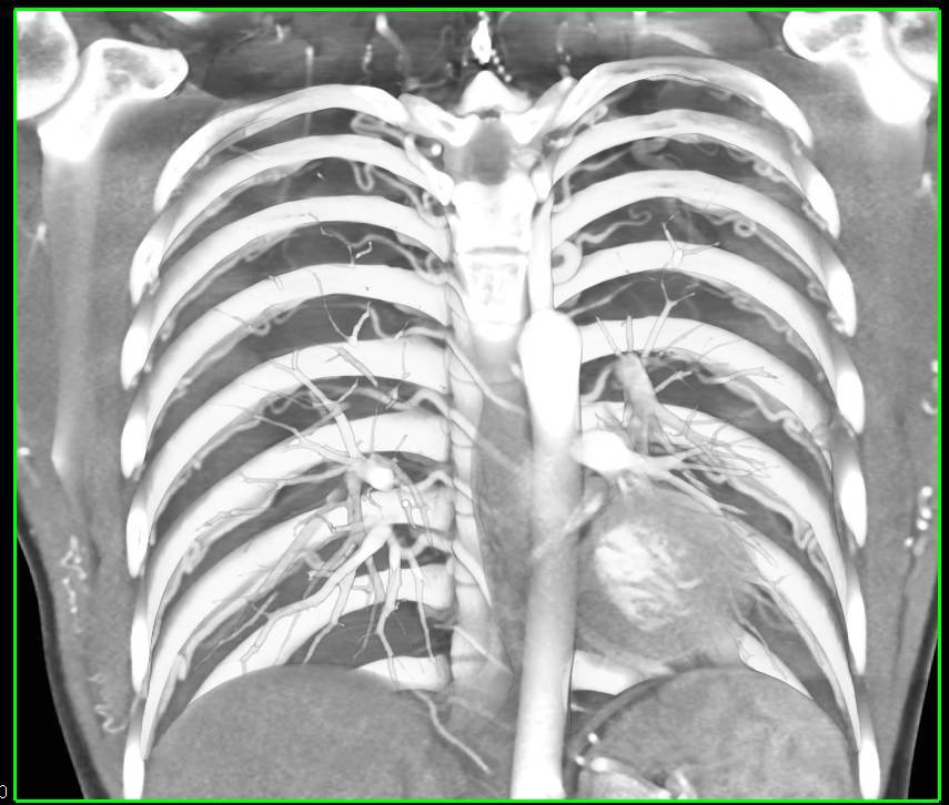 Occlusion of Aortic due to Severe Coarctation of the Aorta with Large Intercostal Arteries - CTisus CT Scan