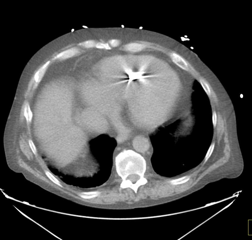 Poor Right Sided Heart Function with Dilated Inferior Vena Cava (IVC) and Hepatic Veins - CTisus CT Scan