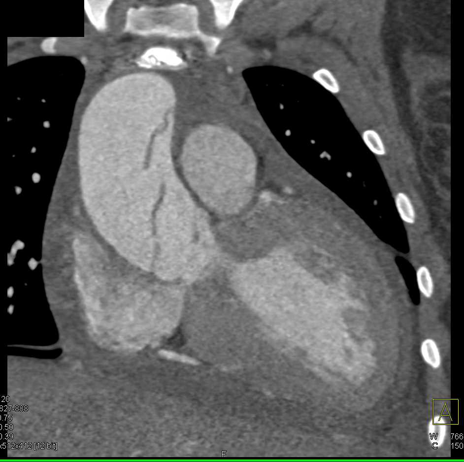 Type A Aortic Dissection - CTisus CT Scan