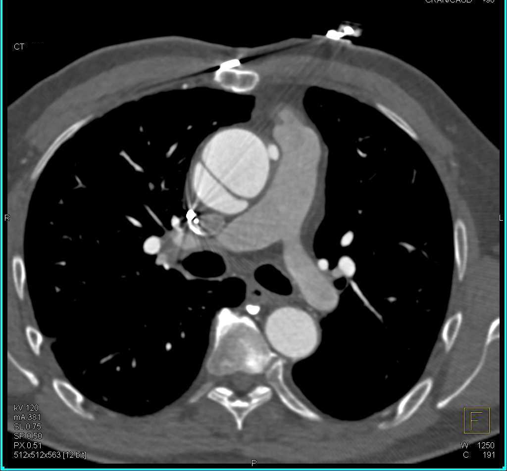 Type A Dissection Nicely Seen with Gated Acquisition - CTisus CT Scan