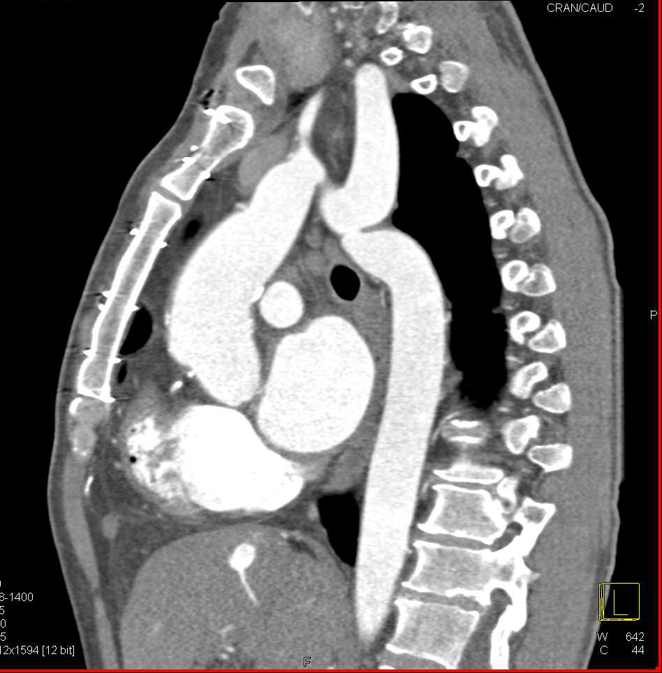 Coarctation of the Aorta with Dilated Left Subclavian Artery - CTisus CT Scan