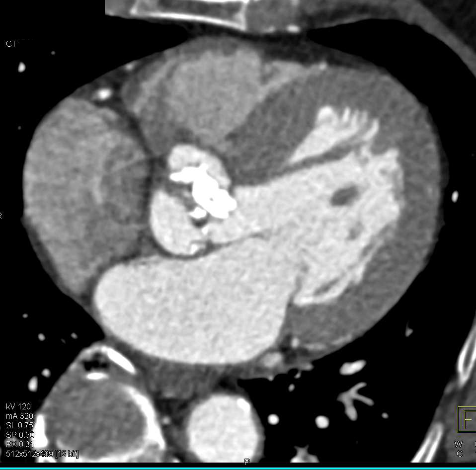Bicuspid valve with Extensive Calcification and Aortic Stenosis - CTisus CT Scan