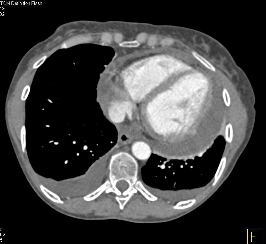 Pericardial Effusion in Renal Transplant Patient - CTisus CT Scan
