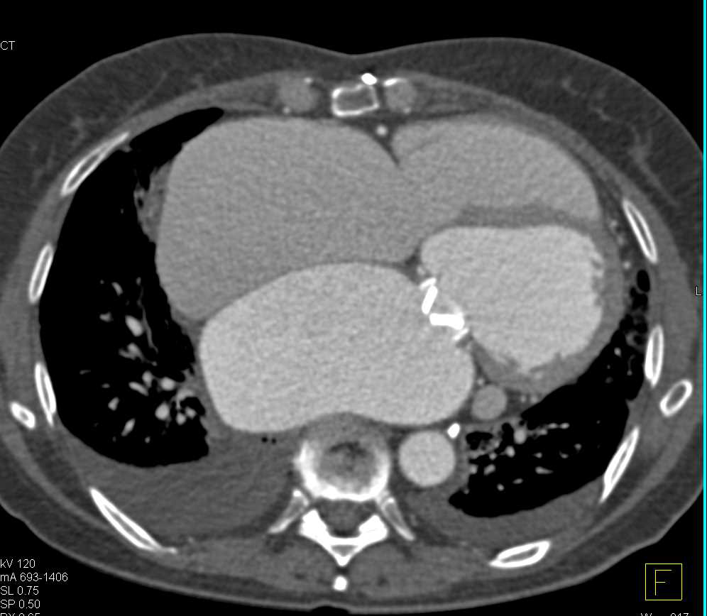 Markedly Dilated Left Atrium with Replaced MVR - CTisus CT Scan