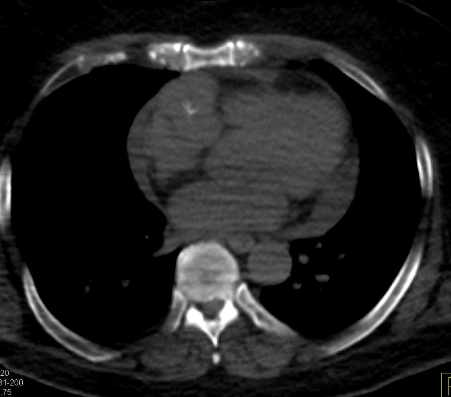 Cardiac Angiosarcoma - CTisus CT Scan