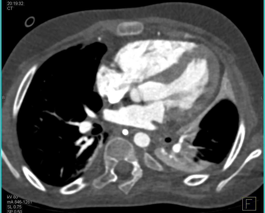 Mucoid Impaction with Left Lower Lung Collapse in a Triple Rule Out Study - CTisus CT Scan