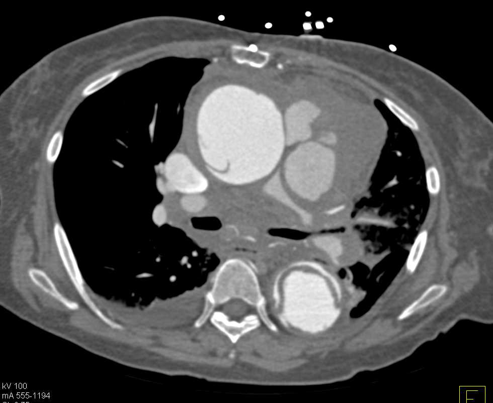 Aortic Dissection with Active Extravasation - CTisus CT Scan