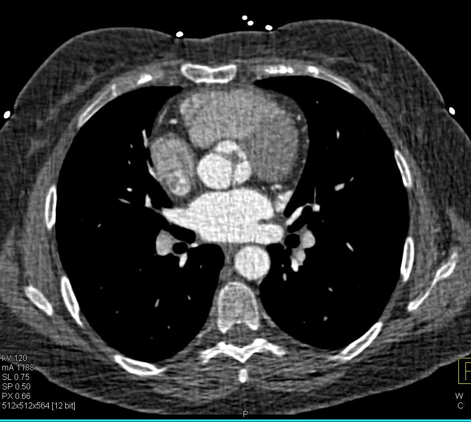 Thickened Aortic Valve Leaflets - CTisus CT Scan