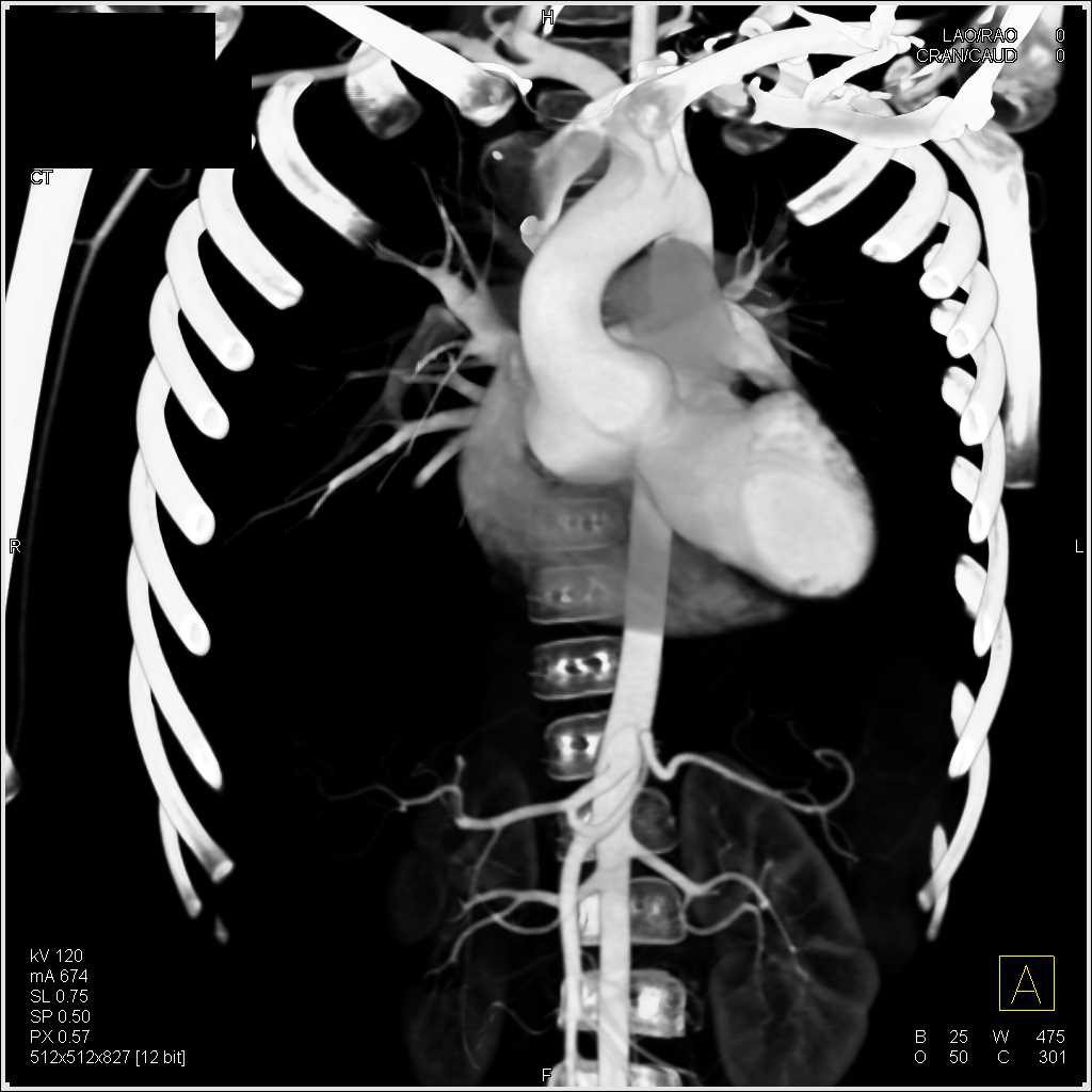 Dilated Aortic Root in Marfan Syndrome - CTisus CT Scan