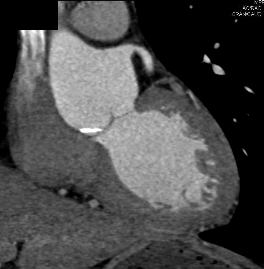 Repair with Stent of Coarctation of the Aorta - CTisus CT Scan