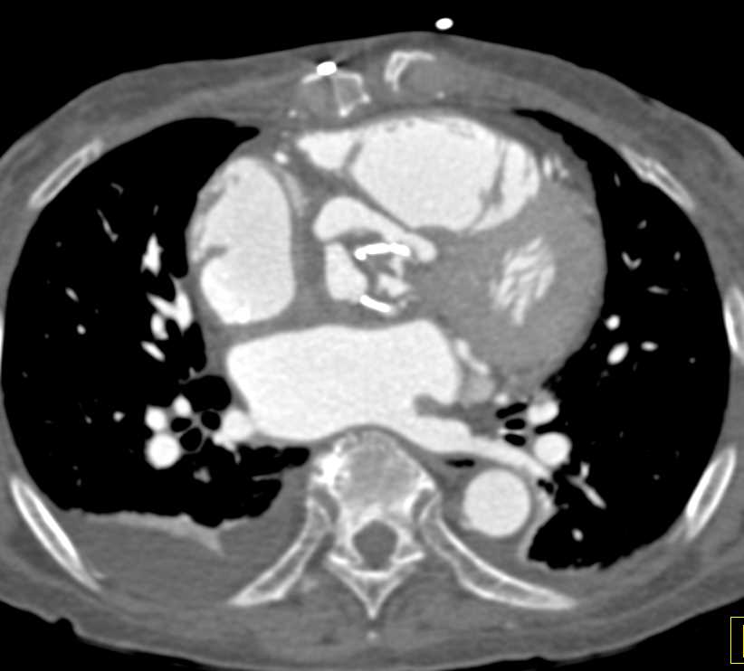 3D of an Aortic Valve Replacement - CTisus CT Scan
