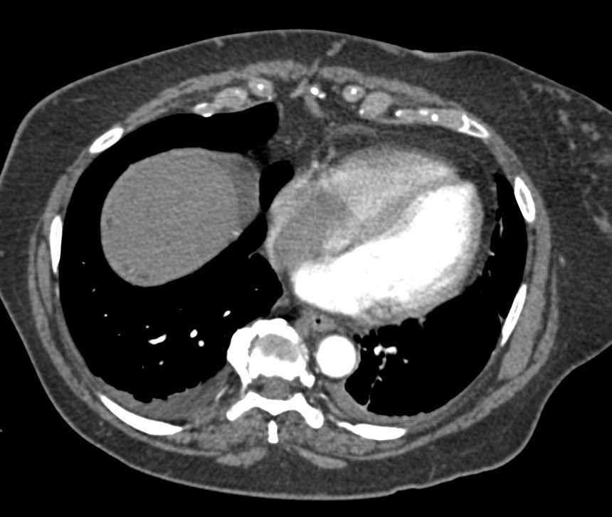 Renal Cell Carcinoma Involves the Renal Vein and Inferior Vena Cava (IVC) and Extends into the Right Atrium - CTisus CT Scan