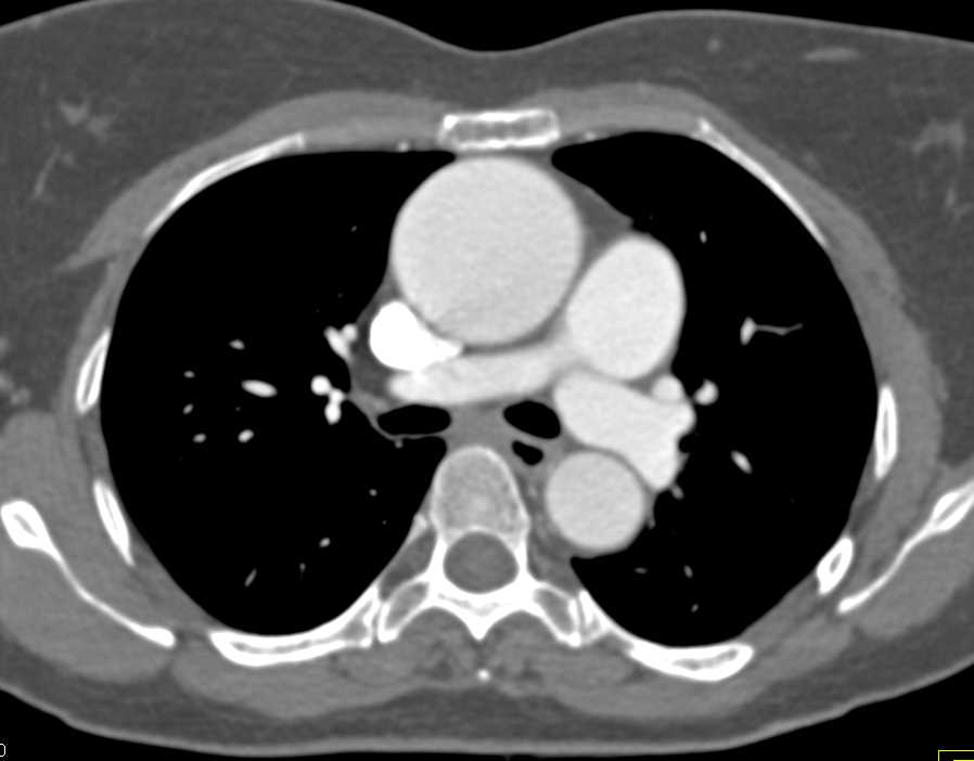 Dilated Aortic Root with Bicuspid Aortic Valve - CTisus CT Scan