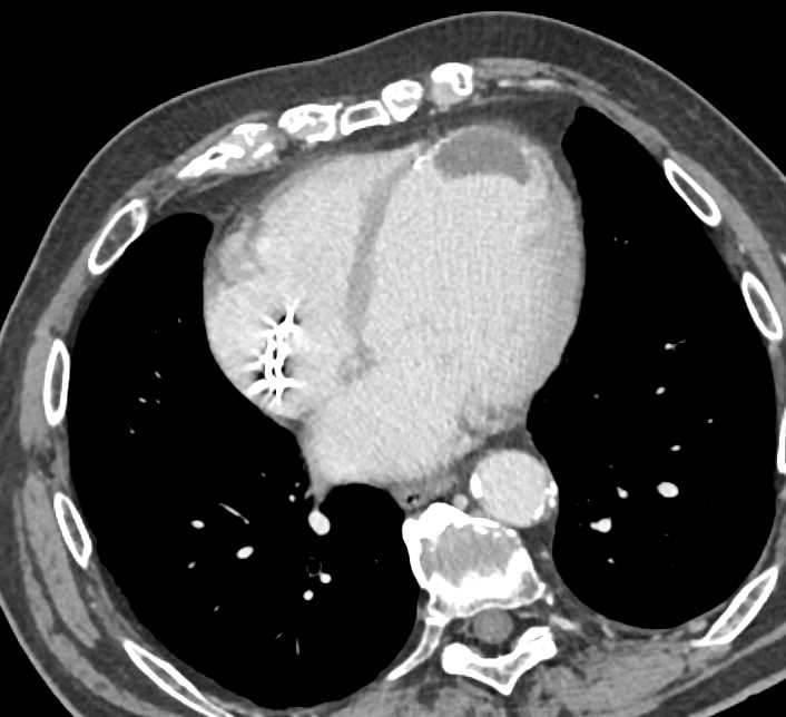 Myocardial Infarction - CTisus CT Scan