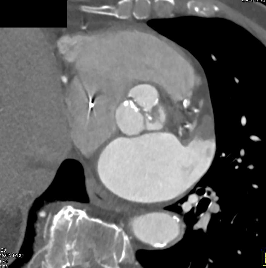 Aortic Valve Calcification - CTisus CT Scan