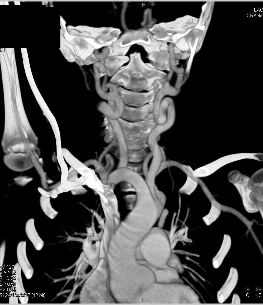 Loeys-Dietz Syndrome with Ectatic Carotid Arteries - CTisus CT Scan