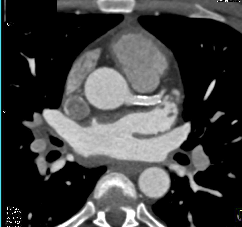 CCTA: Stent in Left Anterior Descending Coronary Artery (LAD) That is Patent - CTisus CT Scan