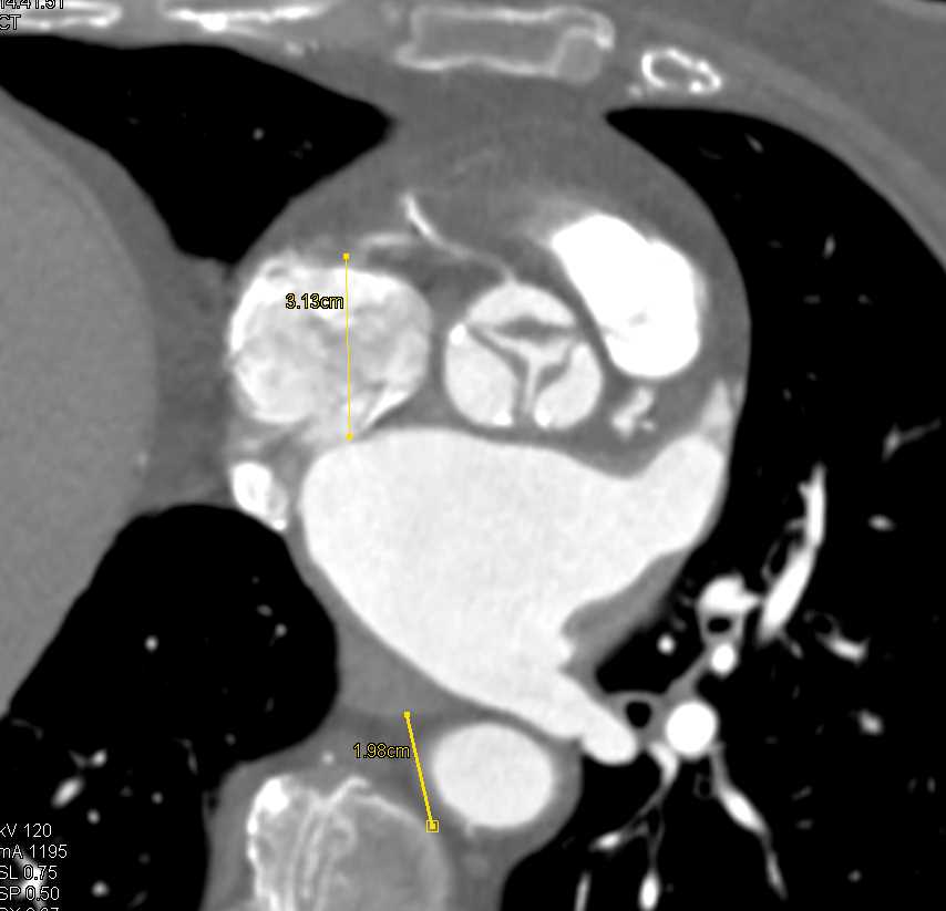 Thickening and Calcification of Aortic Valve Leaflets and Aortic Valve Stenosis - CTisus CT Scan