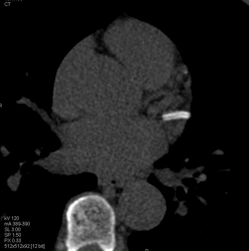 CCTA with Stent in the Left Circumflex Coronary Artery - CTisus CT Scan