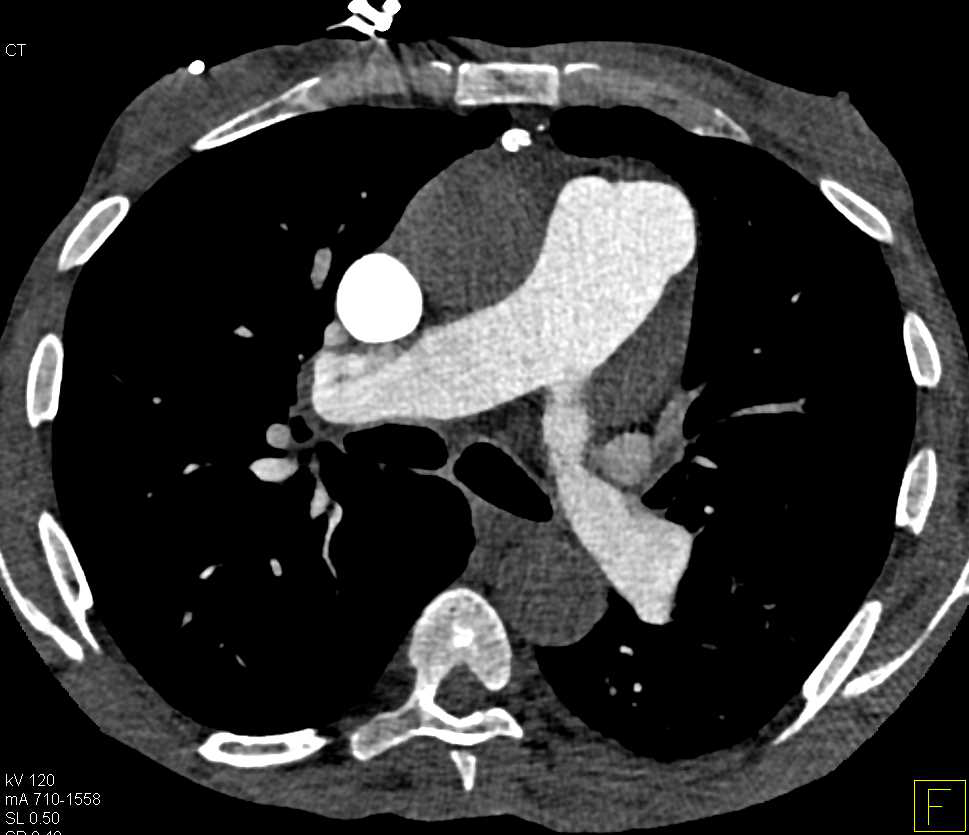 Poor Cardiac Output on Gated Study - CTisus CT Scan