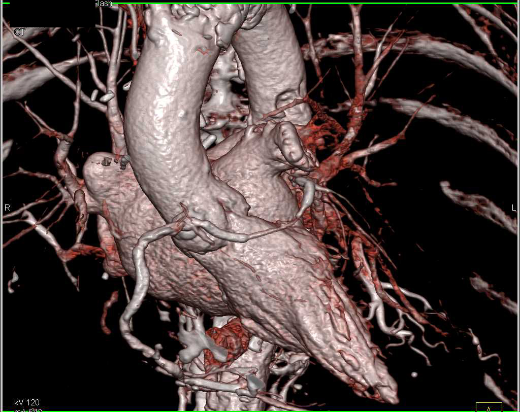 CCTA with Left and Right Main Coronary Artery off a Single Trunk - CTisus CT Scan