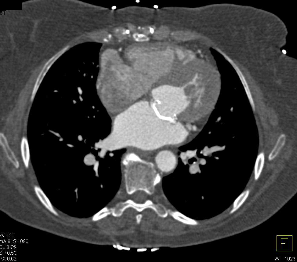 Aortic Valve Disease and Mitral Valve Replacement - CTisus CT Scan