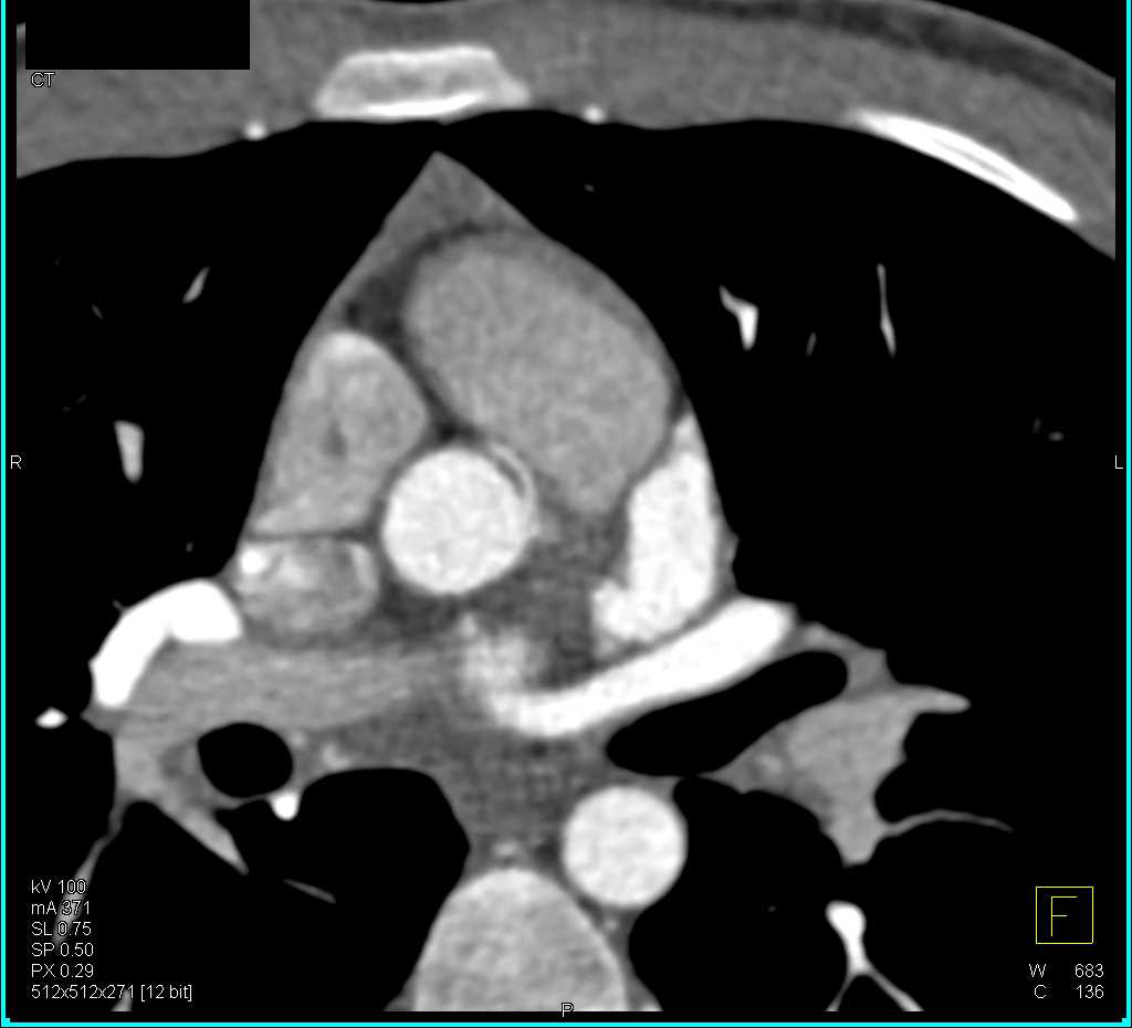 CCTA with Right Coronary Artery (RCA) Arising off Left Cusp in Malignant Configuration - CTisus CT Scan