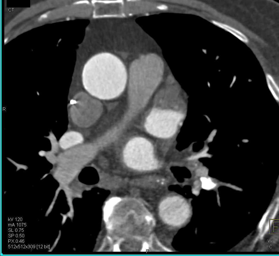 Pseudothrombus in the Left Atrial Appendage - CTisus CT Scan